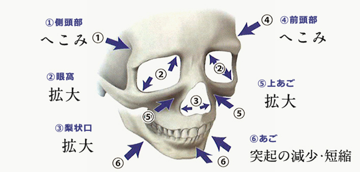 その１　側頭部　へこみ。その２　眼窩　拡大。その３　梨状口　拡大。その４　前頭部　へこみ。その５　上あご　拡大。その６　あご　突起の減少・短縮。