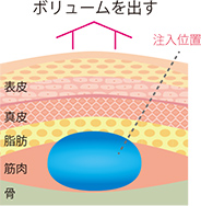 注入位置の説明図。ボリュームを出す