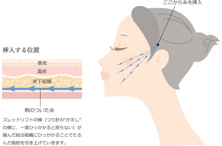 スレッドリフトの挿入イメージ図
