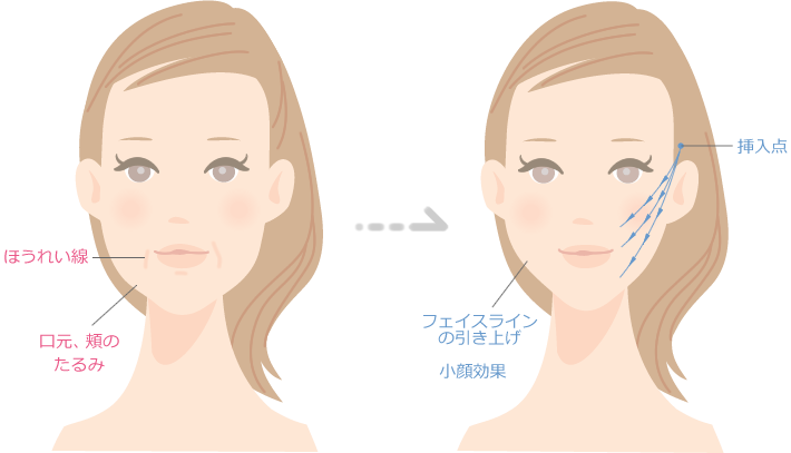 スレッドリフト施術方法