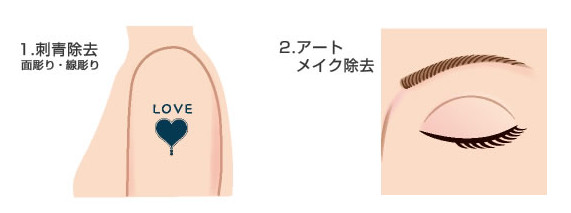 刺青除去・アートメイク除去