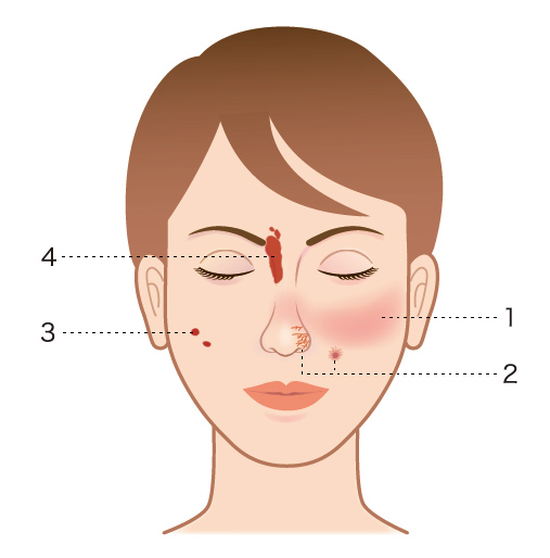 赤ら顔を解消する方法。 9. 美容医療での赤ら顔治療