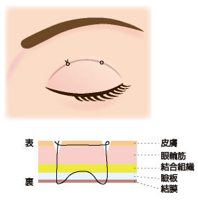 二重埋没法①