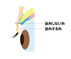 小切開法②