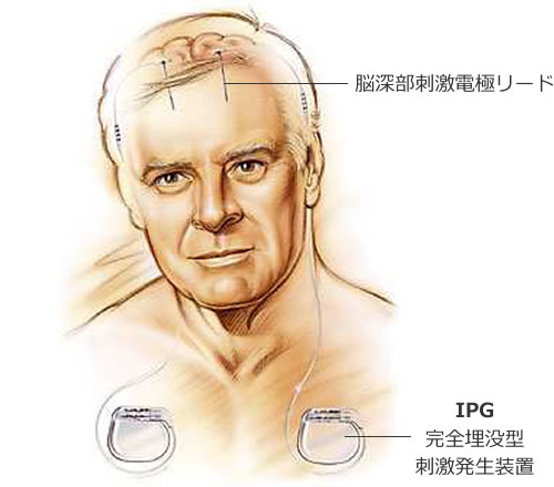 DBS（脳深部刺激療法）とは