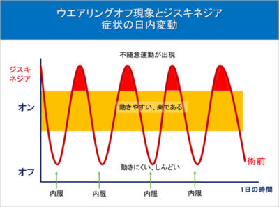 ウエアリングオフ現象とジスキネジア症状の日内変動