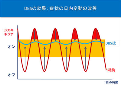 DBS治療の効果（パーキンソン病：症状の日内変動の改善）