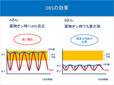 DBS治療の効果（パーキンソン病薬「ドパアミン製剤」への反応性とDBSの効果）