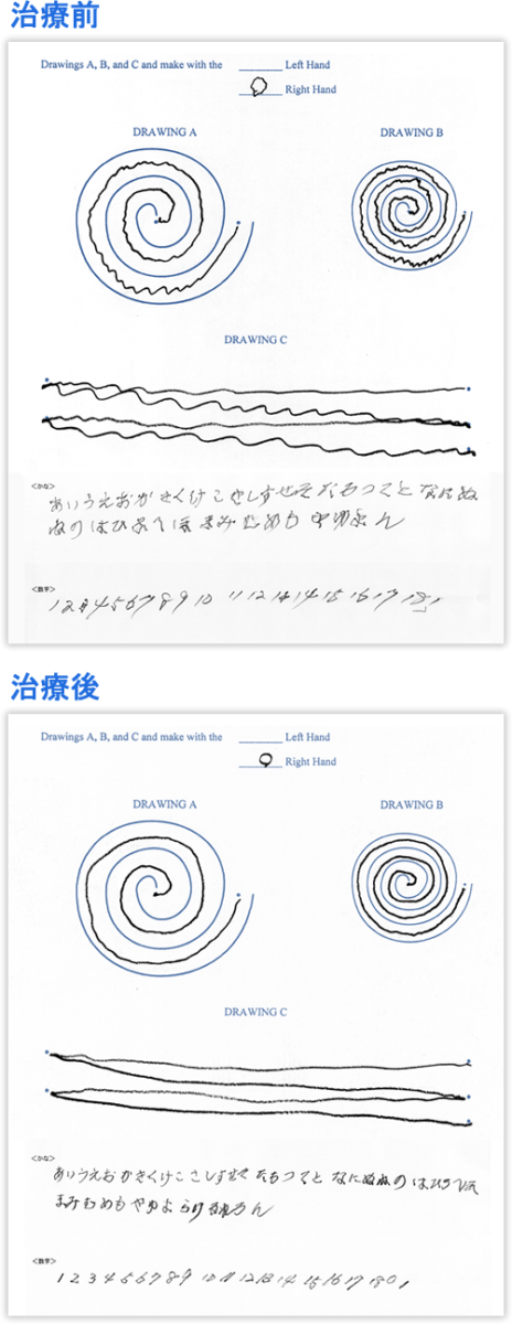 本態性振戦に対する熱凝固療法の治療効果例