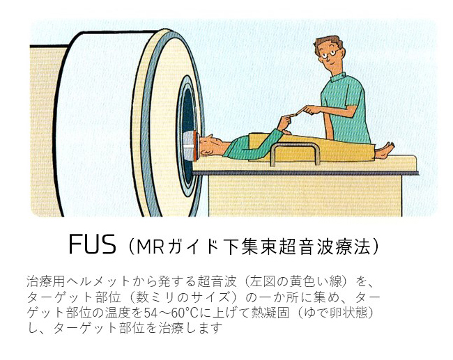 FUS（MRガイド下集束超音波療法）治療法ヘルメットから発する超音波をターゲット部位（数ミリのサイズ）の一か所に集め、ターゲット部位の温度を54～60℃に上げて熱凝固（ゆで卵状態）し、ターゲット部位を治療します。