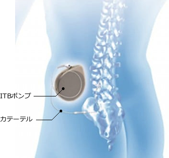 ITB療法（バクロフェン髄注療法）