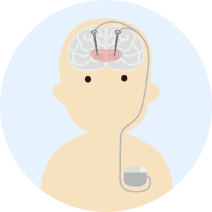 DBSは脳の深部を可逆的に刺激を行うことでパーキンソン病、本態性振戦、ジストニアなどの症状を改善する治療です。