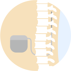 SCSは脊髄を刺激することで、神経障害性の痛みを緩和することが可能です。