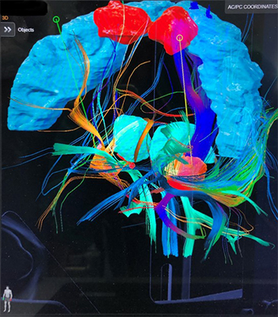 手術支援システム ソフトウェア  脳図像