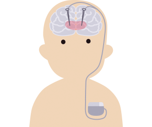 DBS治療(脳深部刺激療法)