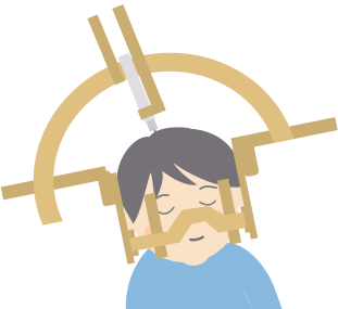 熱凝固療法(定位的脳手術)