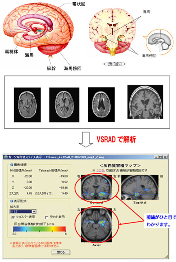 VSRAD(ブイエスラド：早期アルツハイマー型認知症診断支援システム)とは