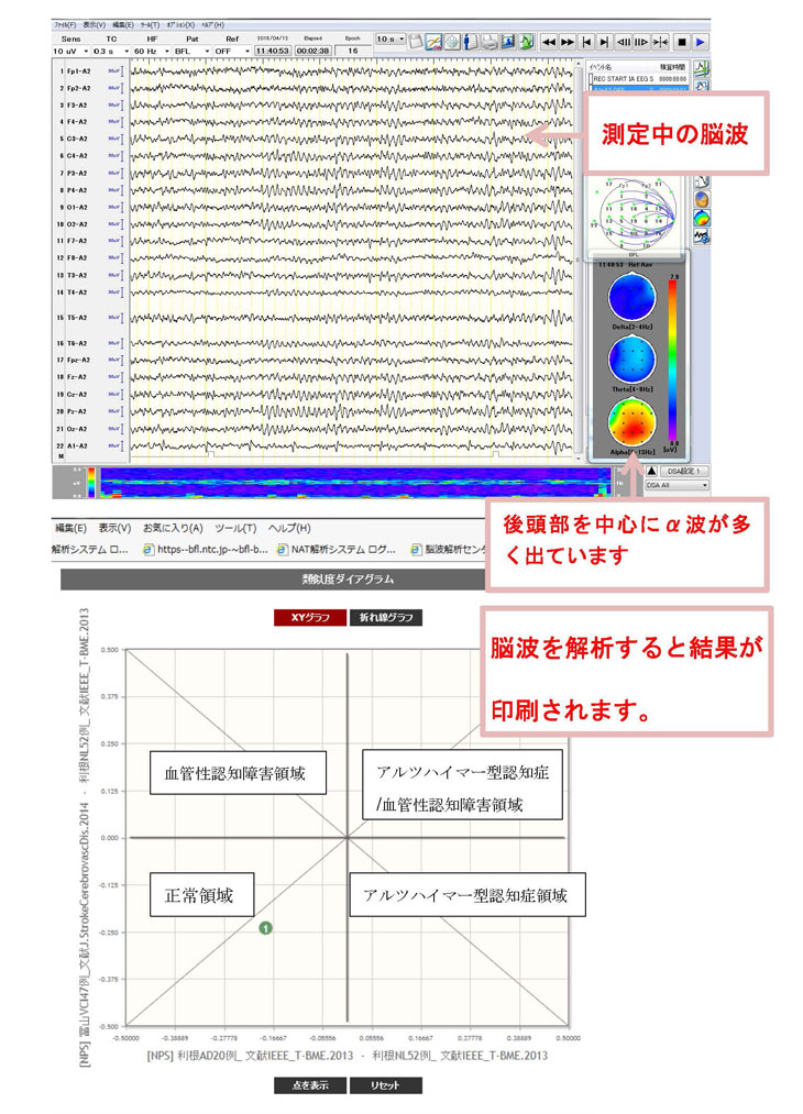 VSRAD(ブイエスラド：早期アルツハイマー型認知症診断支援システム)とは