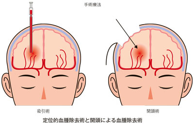 イラスト:定位的血腫除去術と開頭による血腫除去術